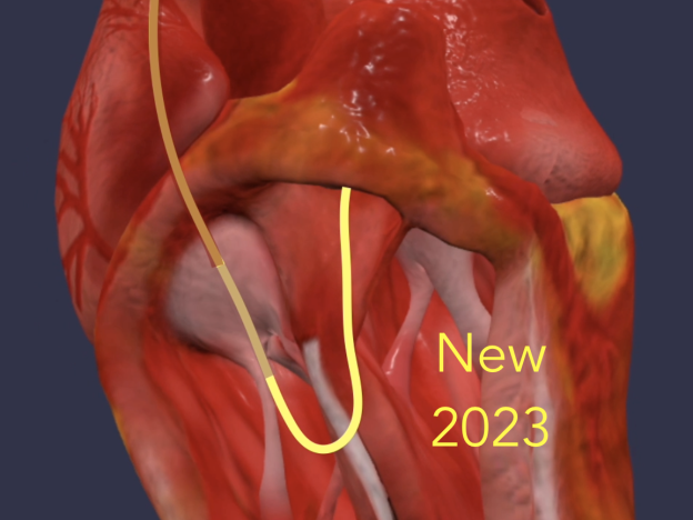 The Right Heart Cath